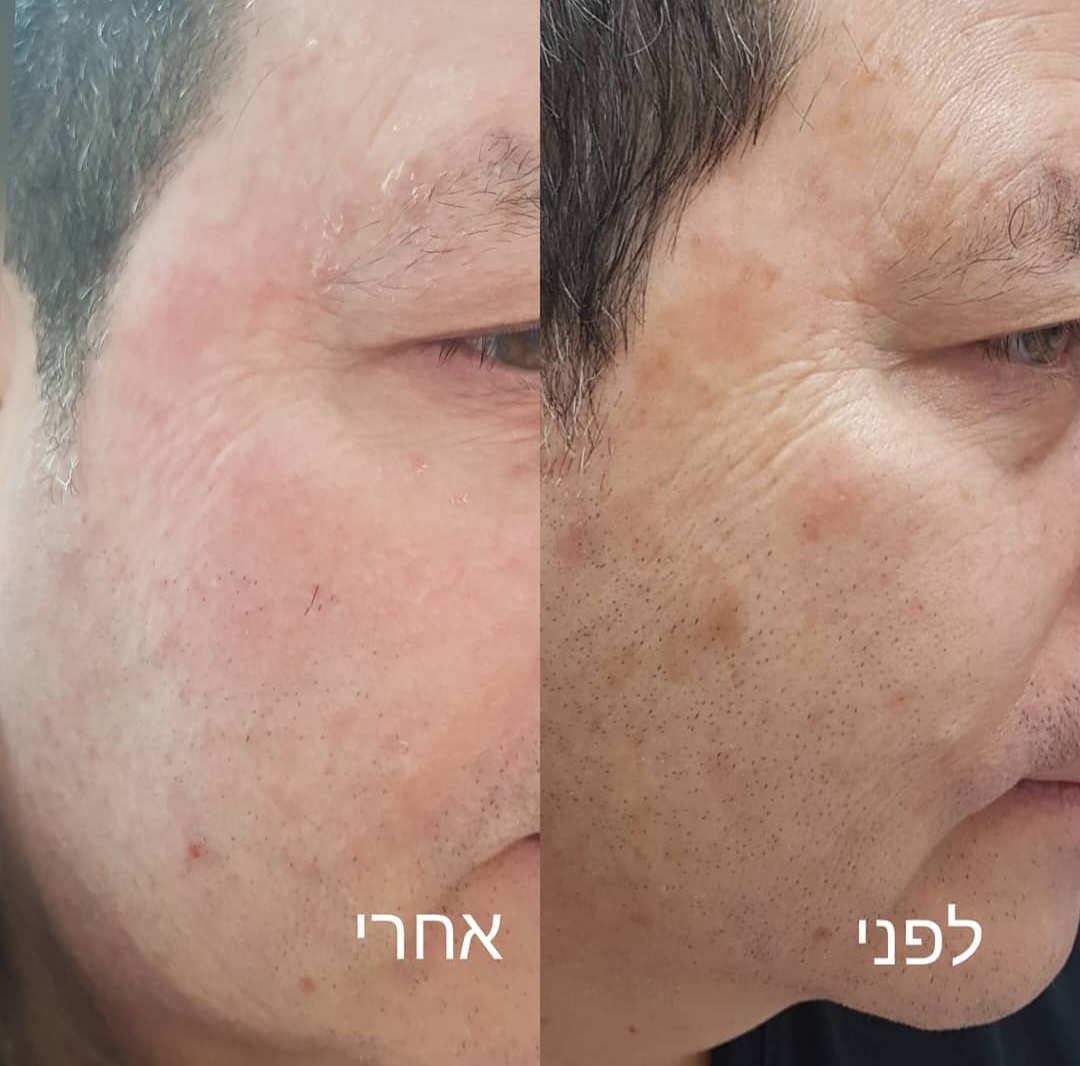 טיפול בפיגמנטציה לגברים בנתניה לפני ואחרי