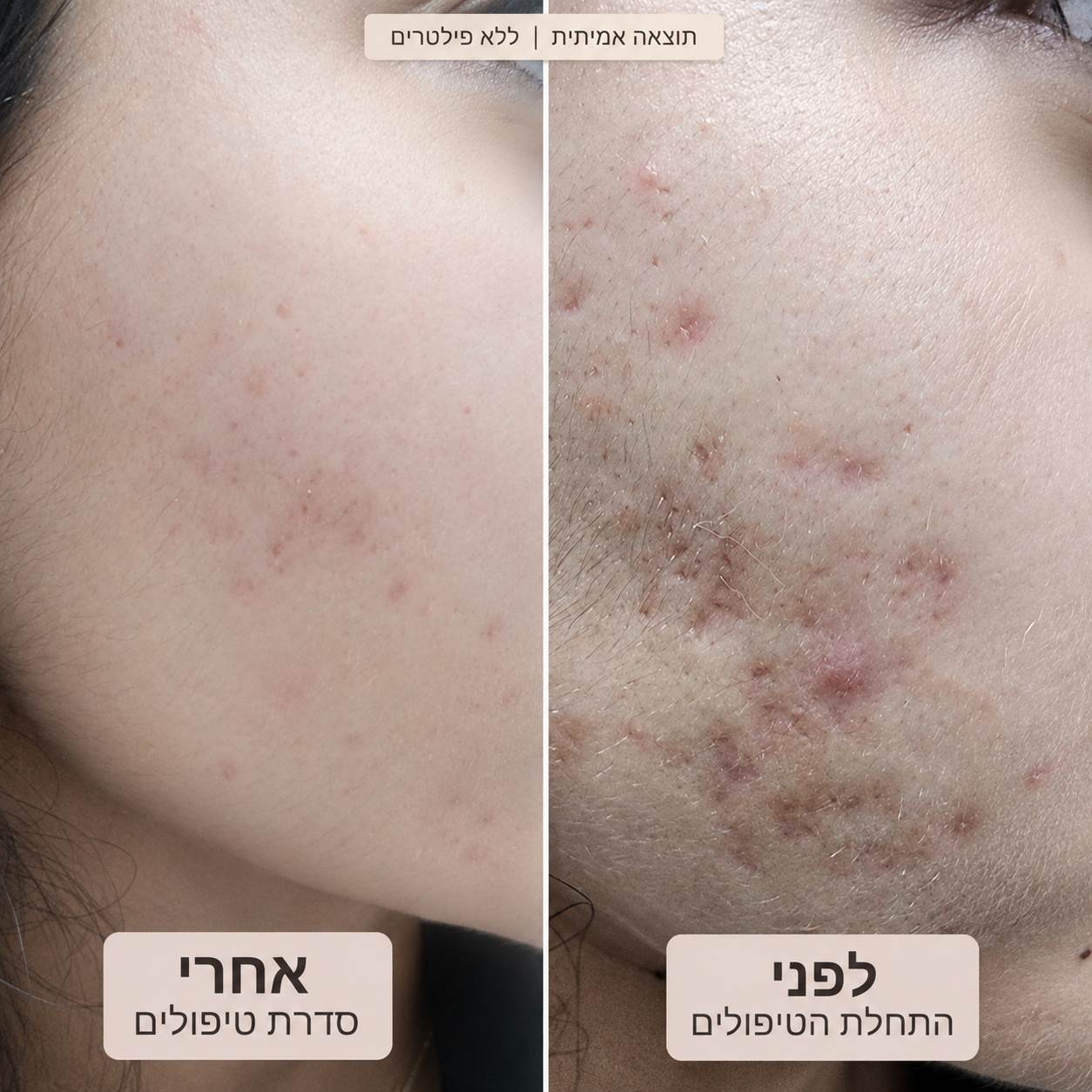 טיפול FixeR RF Microneedling – לפני ואחרי סדרת טיפולים לצלקות אקנה